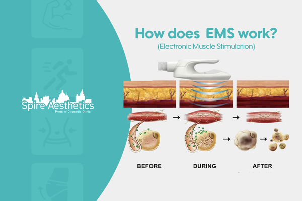 EMS treatment for post pregnancy weight loss treatment Stamford