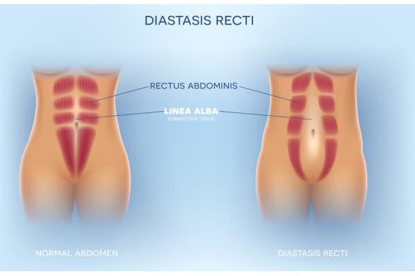 What Non-Surgical Options Are Available for Diastasis Recti Stamford?