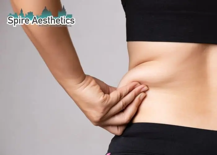 Image of woman pinching fat on their hips Stamford. Fat Freezing treatment