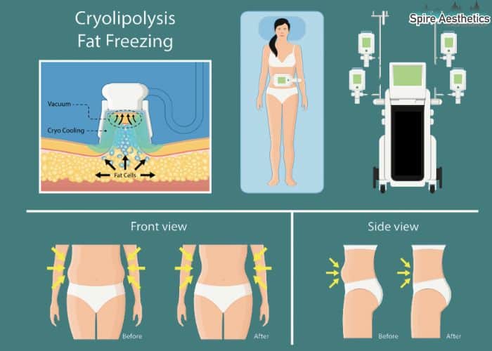 Image of diet and fat freezing combined for best results for Spire Aesthetics Stamford