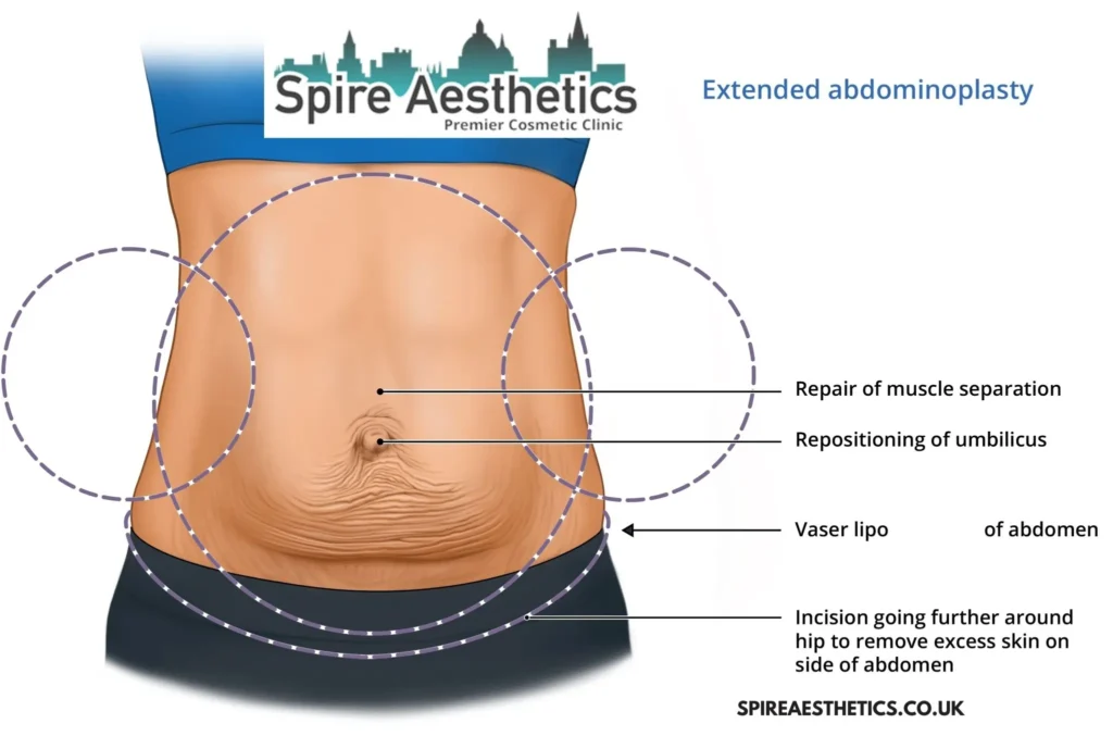 Understanding Loose Skin After Gastric Band Stamford Surgery and HIFU Treatment