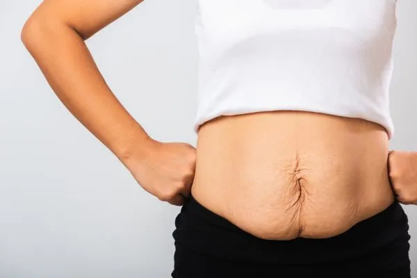 Image of a woman's stomach after weight loss with sagging skin following a gastric band Stamford