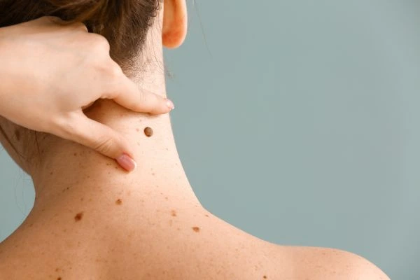 skin blemish removal Stamford treatment