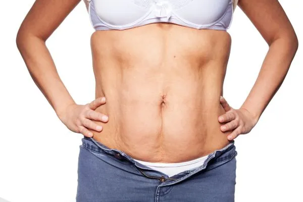 sagging skin on woman's stomach after weight loss injections Stamford
