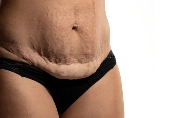 Image of womans stomach after weight loss injections Stamford showing saggy skin