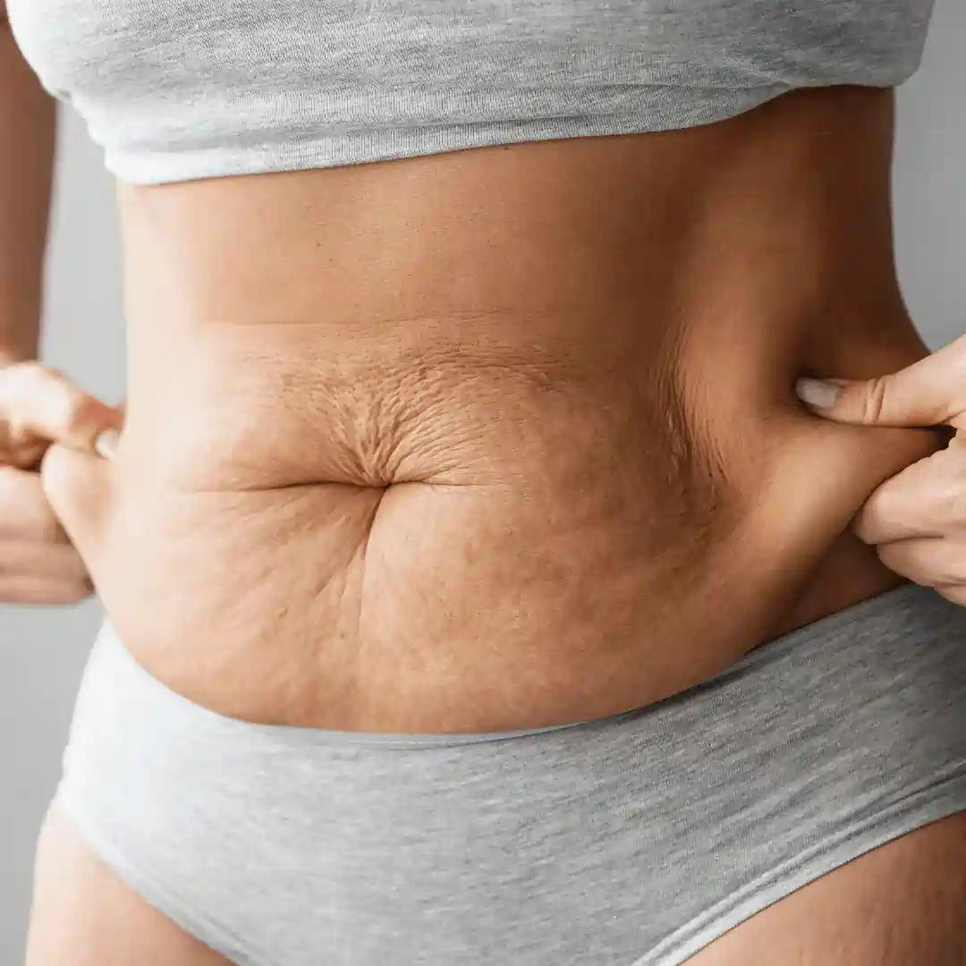Is It Normal to Have Loose Skin After Pregnancy Stamford?