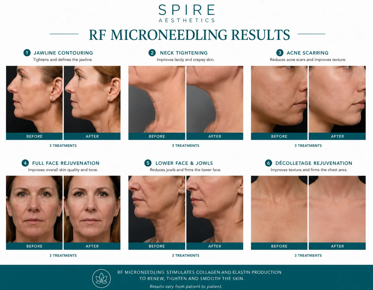 RF Microneedling Skin tightening Stamford results
