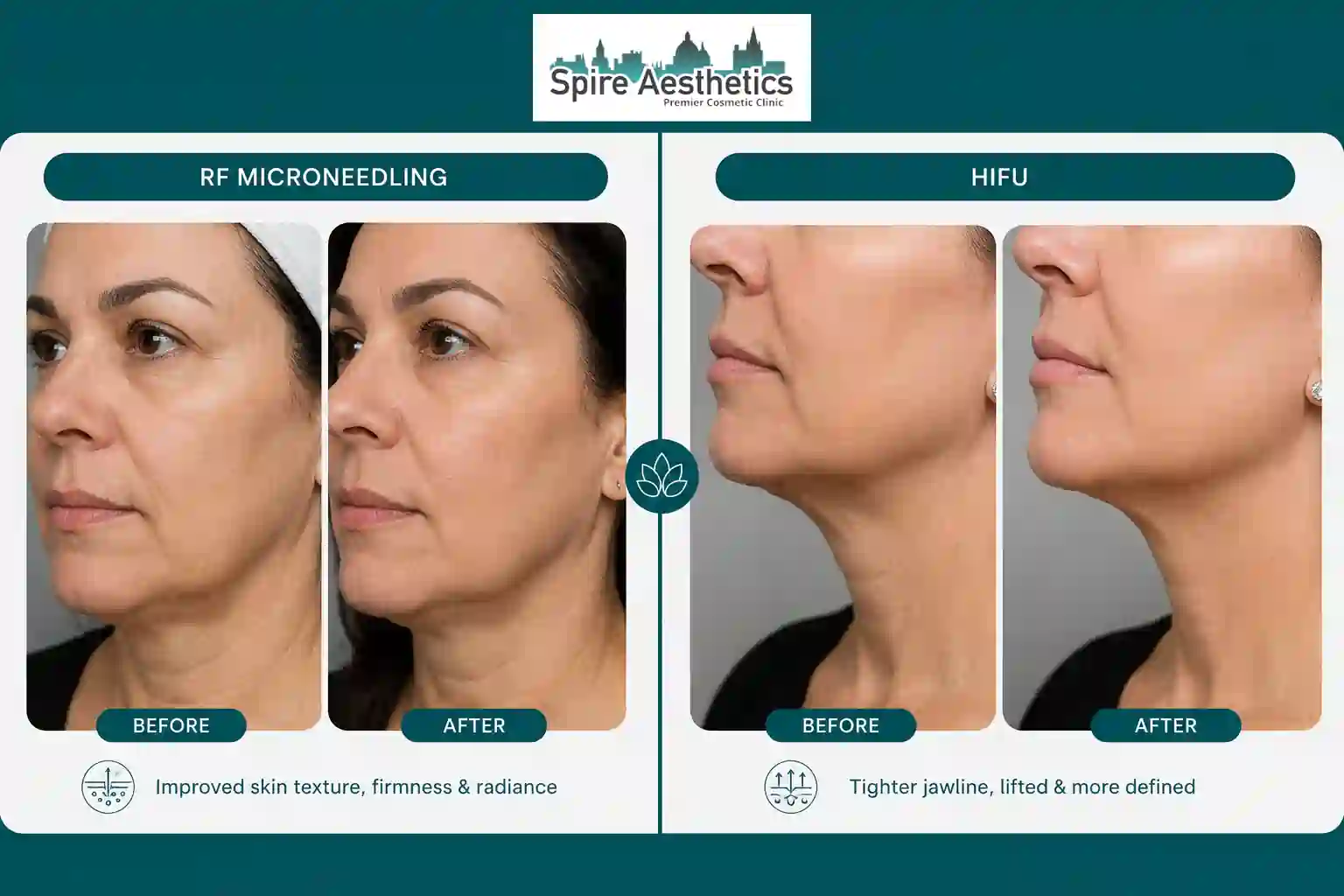 Can RF Microneedling and HIFU Be Combined Stamford?