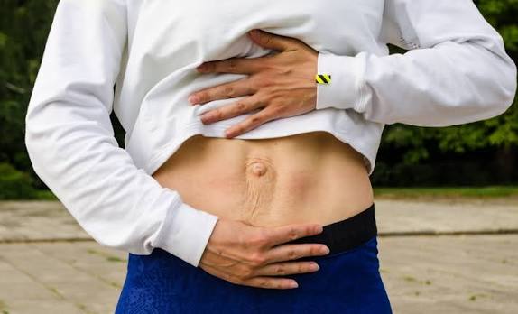 When Could Diastasis Recti Be the Missing Piece of the Puzzle Stamford?