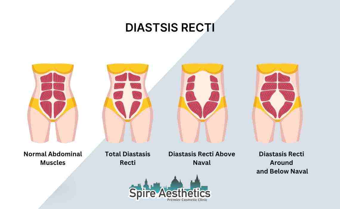 Is Non-Surgical Diastasis Recti Treatment Right for You? Common Concerns Answered Stamford